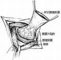 疾病常识_腹股沟直疝修复术